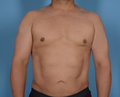 Liposuction Before & After Gallery - Patient 319225 - Image 2