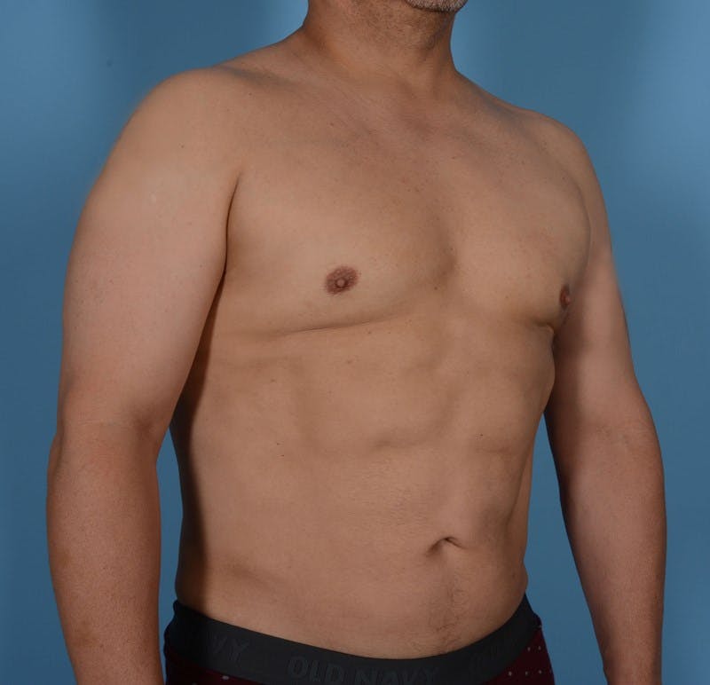 Liposuction Before & After Gallery - Patient 319225 - Image 4