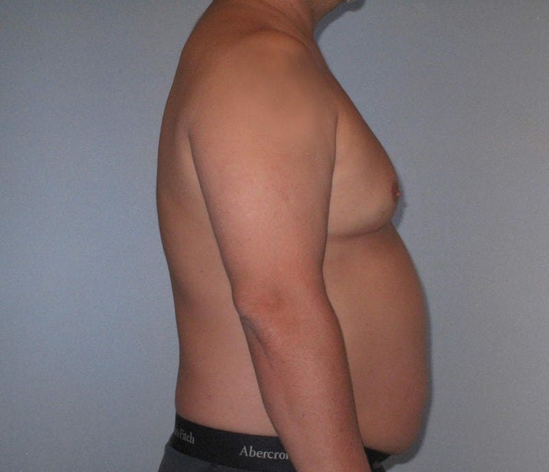 Liposuction Before & After Gallery - Patient 319225 - Image 5
