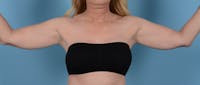 Liposuction Before & After Gallery - Patient 168325 - Image 1