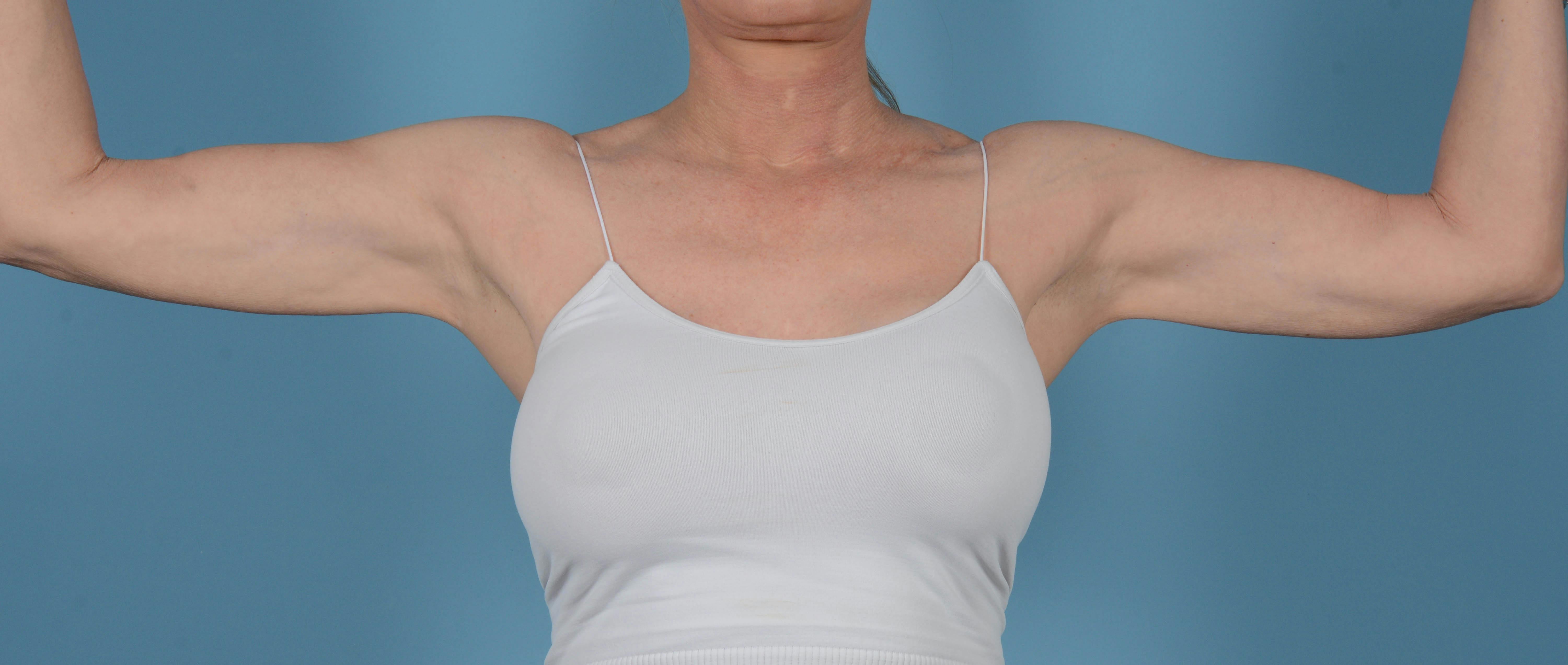 Liposuction Before & After Gallery - Patient 168325 - Image 2