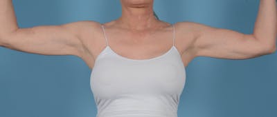 Liposuction Before & After Gallery - Patient 168325 - Image 2