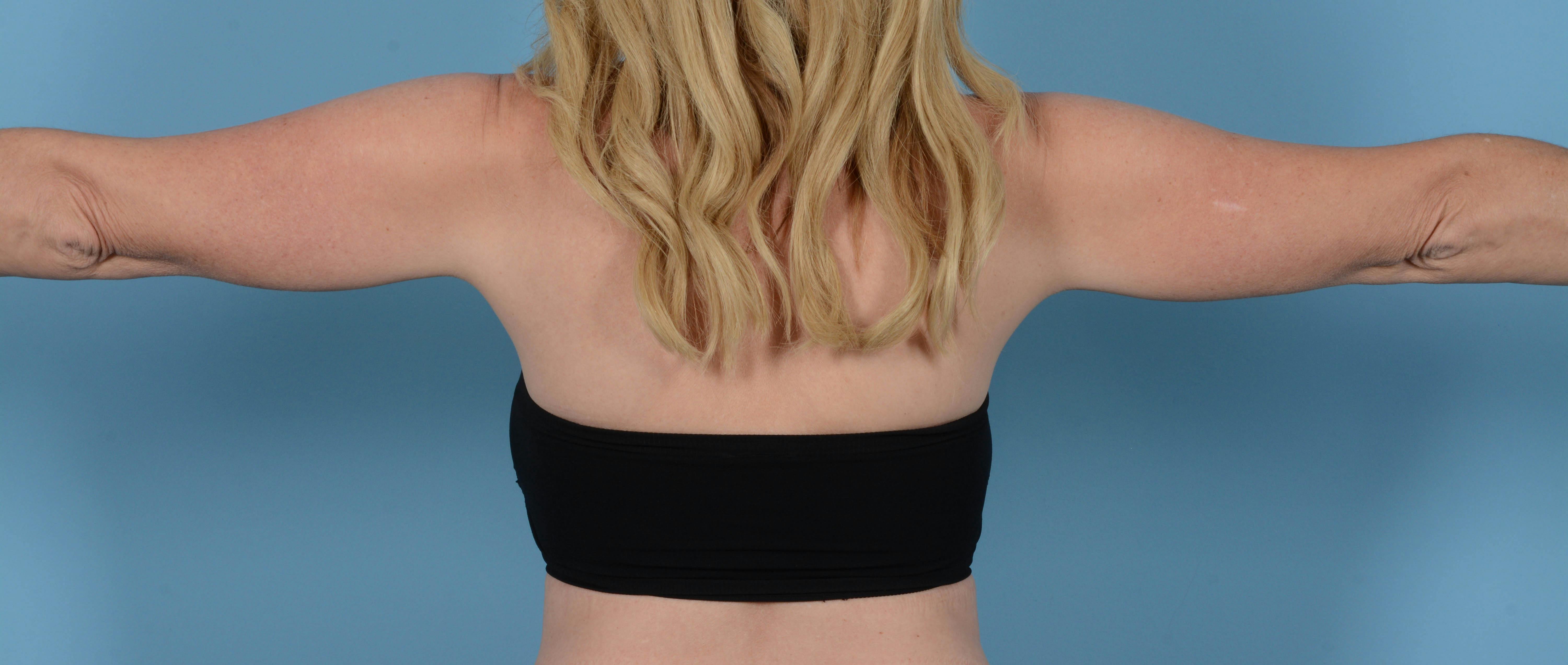 Liposuction Before & After Gallery - Patient 168325 - Image 3