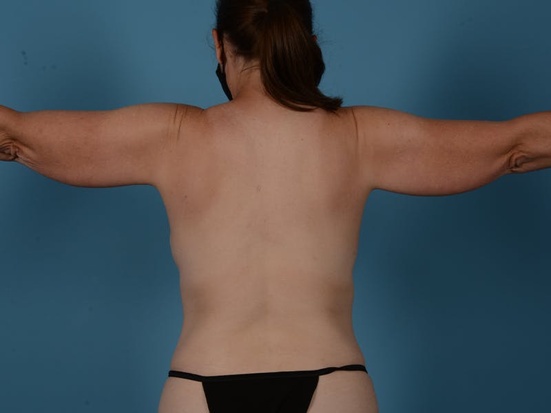 Tummy Tuck Before & After Gallery - Patient 392665 - Image 5