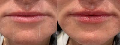 Fillers Before & After Gallery - Patient 256983 - Image 1