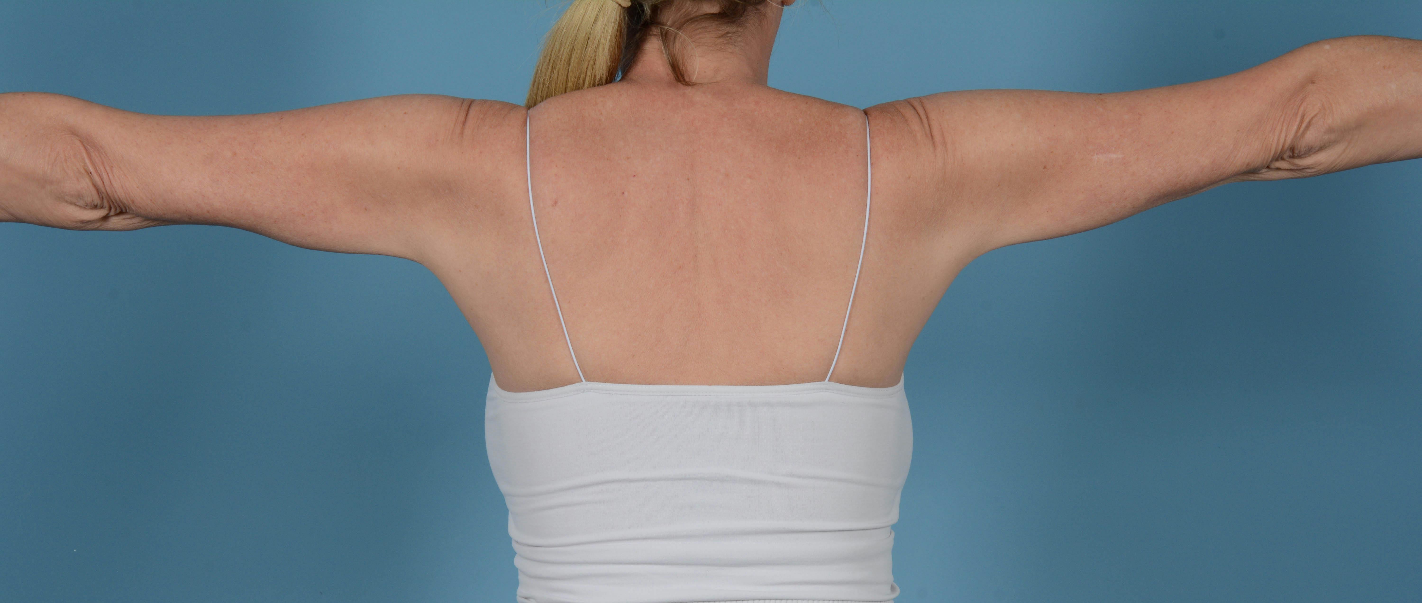 Liposuction Before & After Gallery - Patient 168325 - Image 4