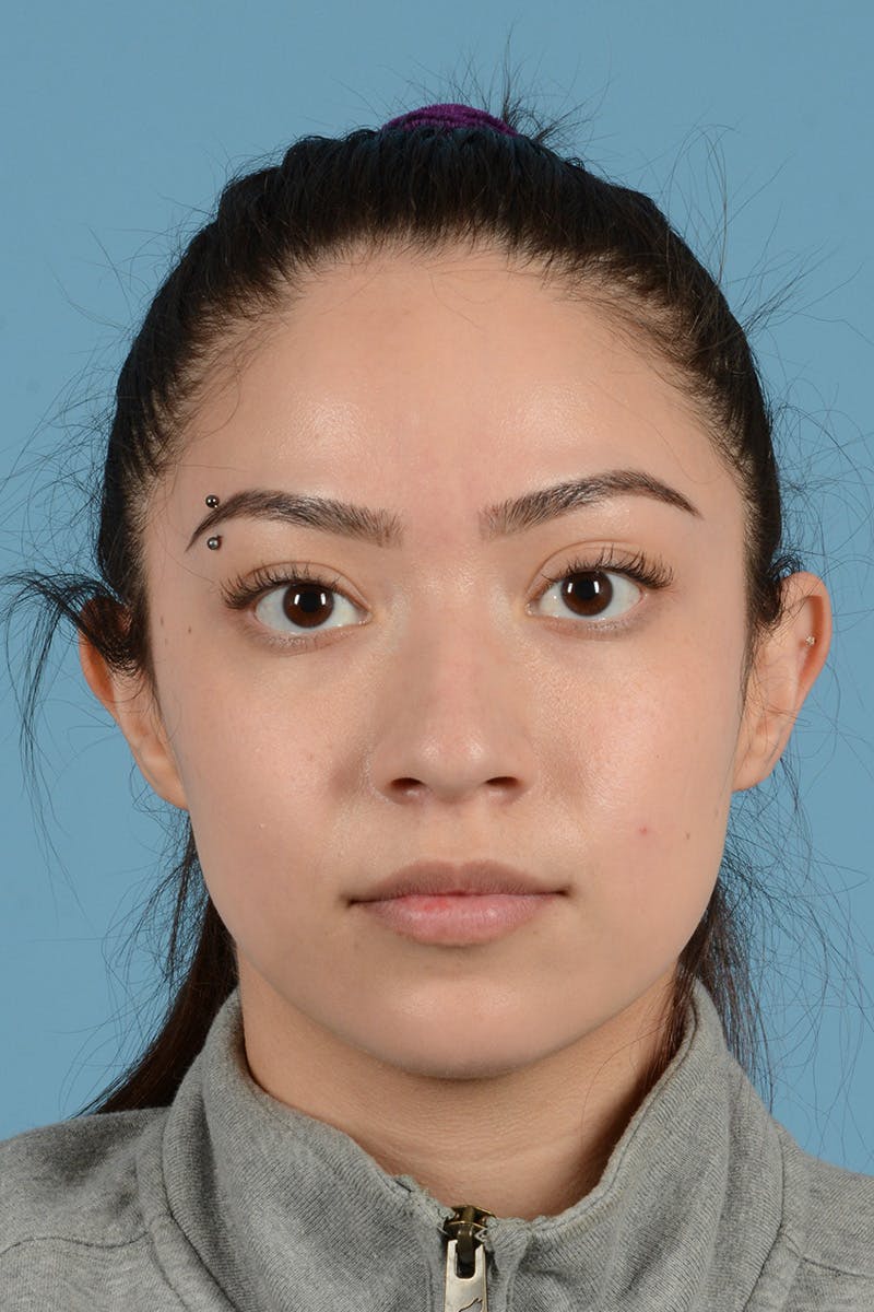 Rhinoplasty Before & After Gallery - Patient 399619 - Image 1