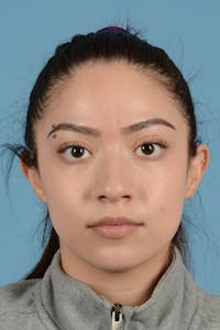 Rhinoplasty Before & After Gallery - Patient 399619 - Image 1