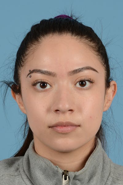 Rhinoplasty Before & After Gallery - Patient 399619 - Image 1
