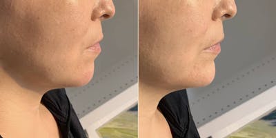 Fillers Before & After Gallery - Patient 217740 - Image 1