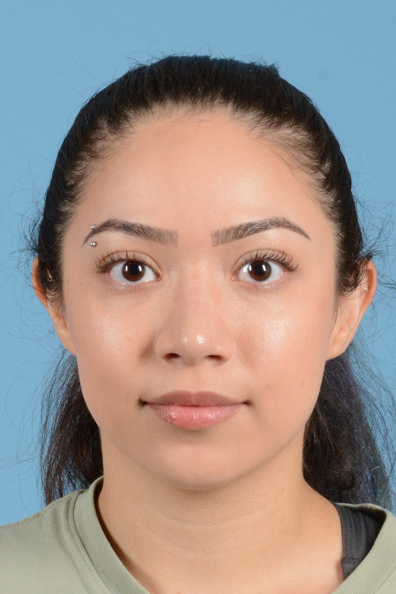 Rhinoplasty Before & After Gallery - Patient 399619 - Image 2