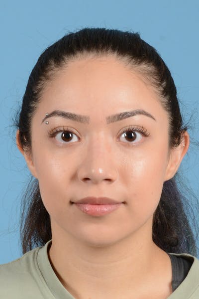Rhinoplasty Before & After Gallery - Patient 399619 - Image 2