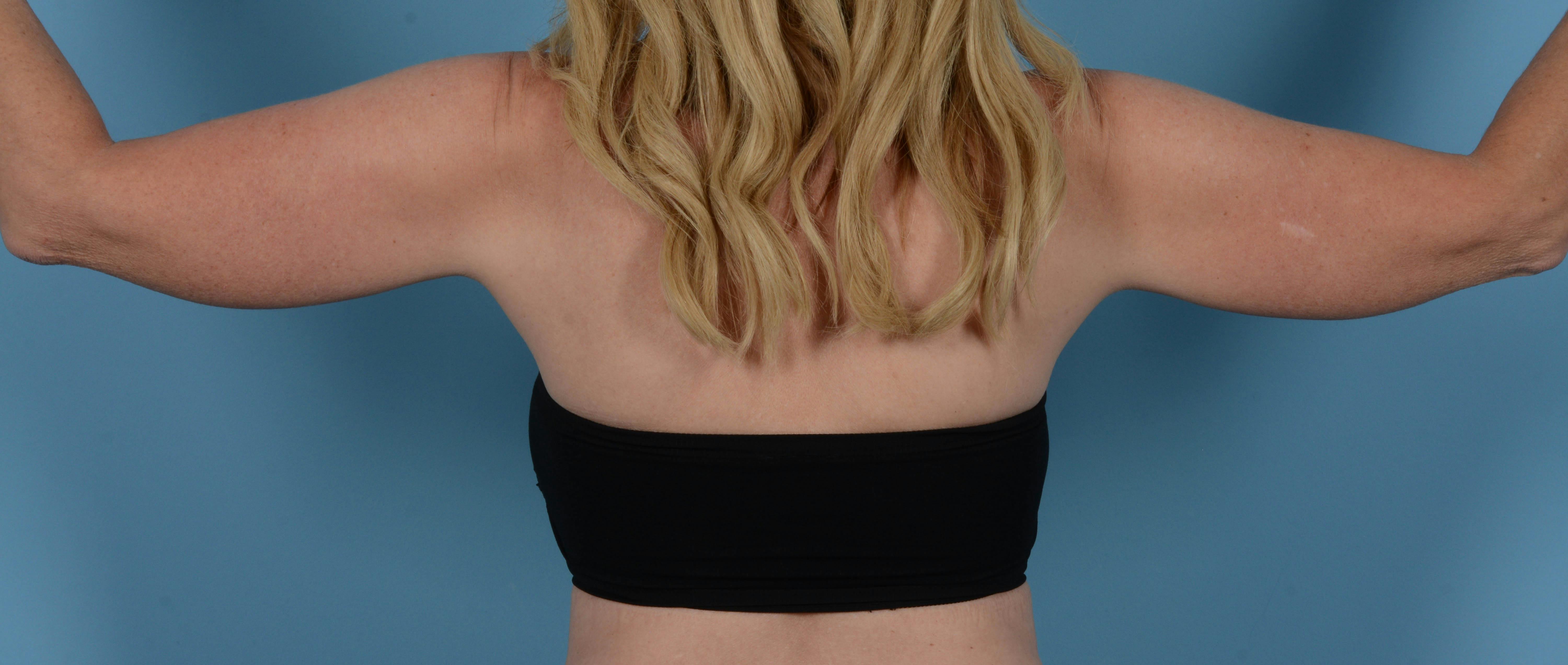 Liposuction Before & After Gallery - Patient 168325 - Image 5