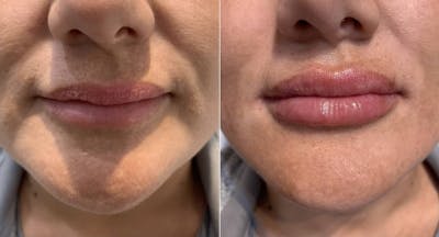 Fillers Before & After Gallery - Patient 136661 - Image 1