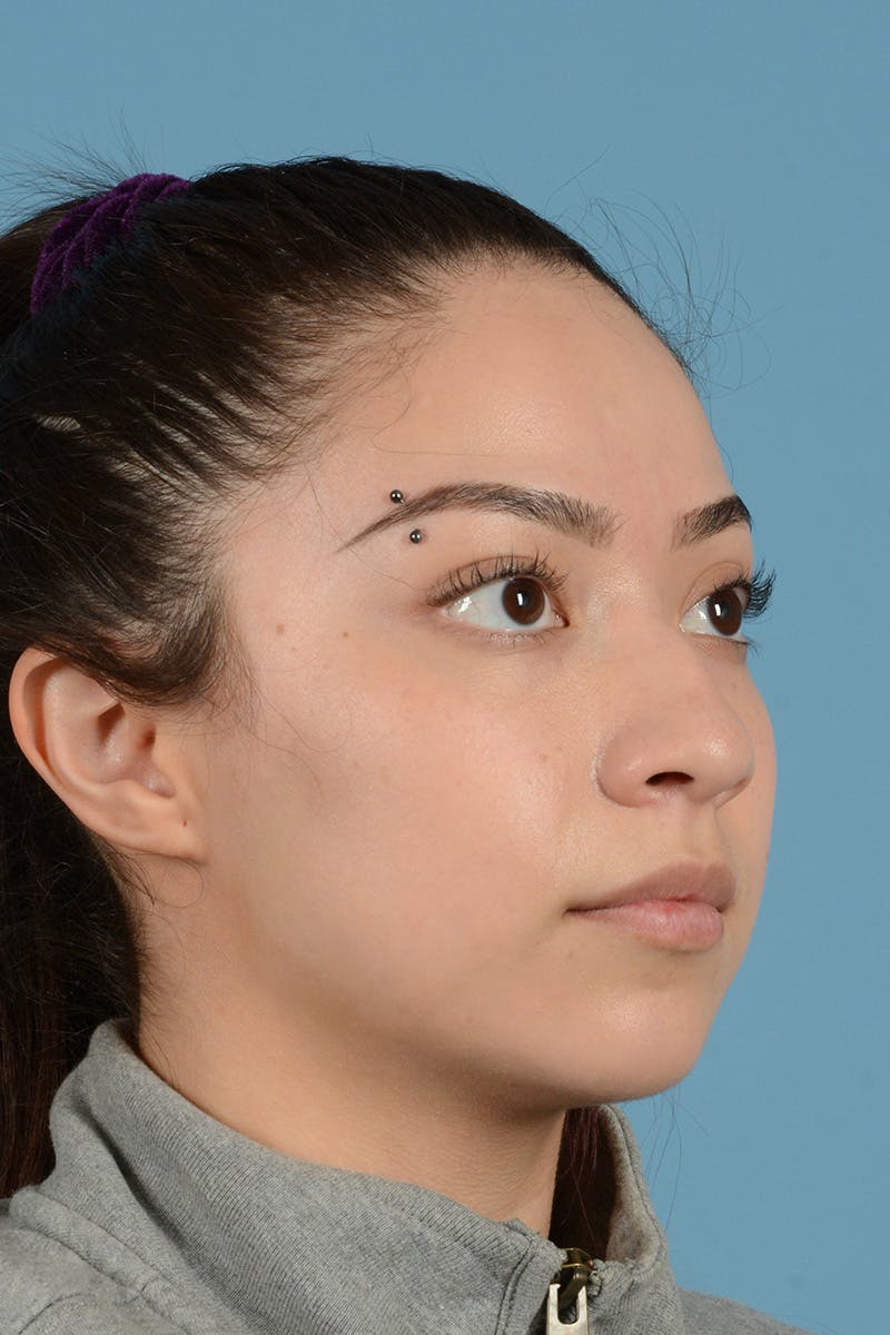 Rhinoplasty Before & After Gallery - Patient 399619 - Image 3