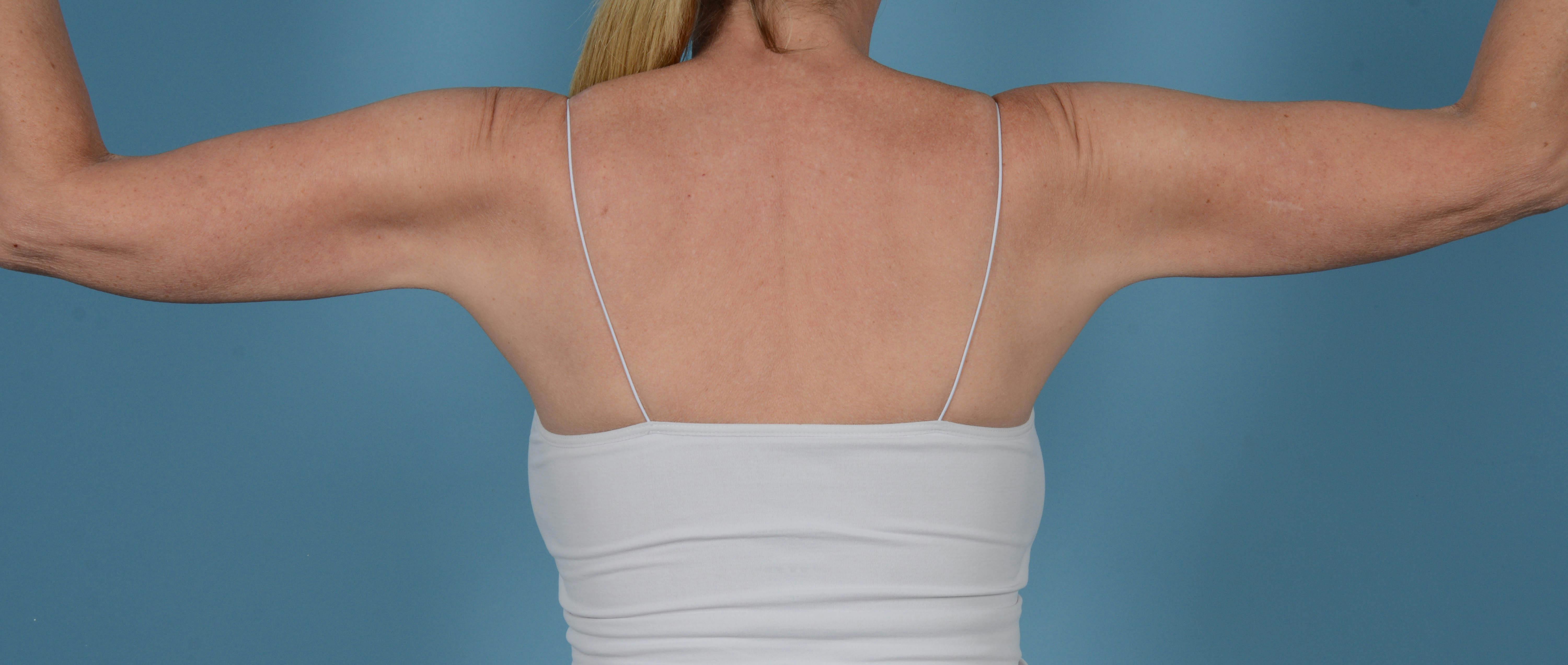 Liposuction Before & After Gallery - Patient 168325 - Image 6