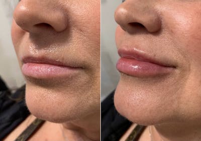 Fillers Before & After Gallery - Patient 139231 - Image 1