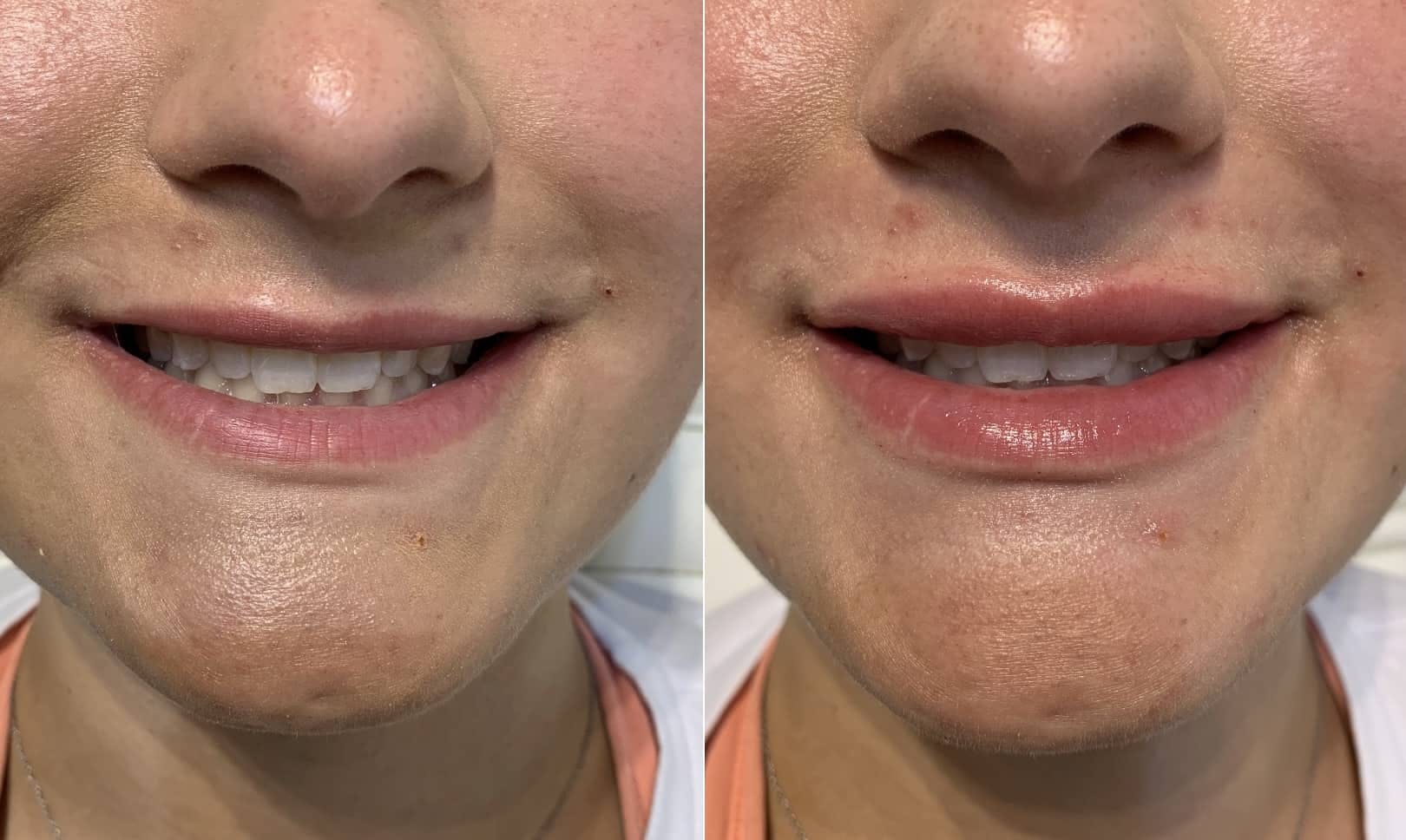 Fillers Before & After Gallery - Patient 453766 - Image 1