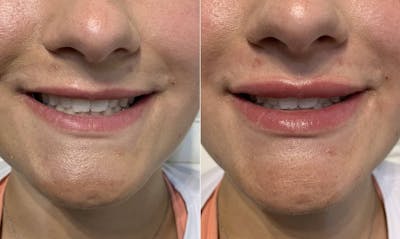 Fillers Before & After Gallery - Patient 453766 - Image 1