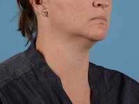 Liposuction Before & After Gallery - Patient 371397 - Image 1