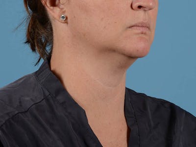 Liposuction Before & After Gallery - Patient 371397 - Image 1