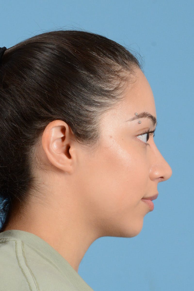 Rhinoplasty Before & After Gallery - Patient 399619 - Image 6