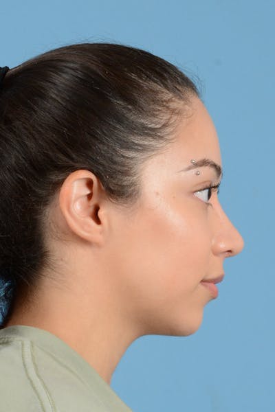 Rhinoplasty Before & After Gallery - Patient 399619 - Image 6