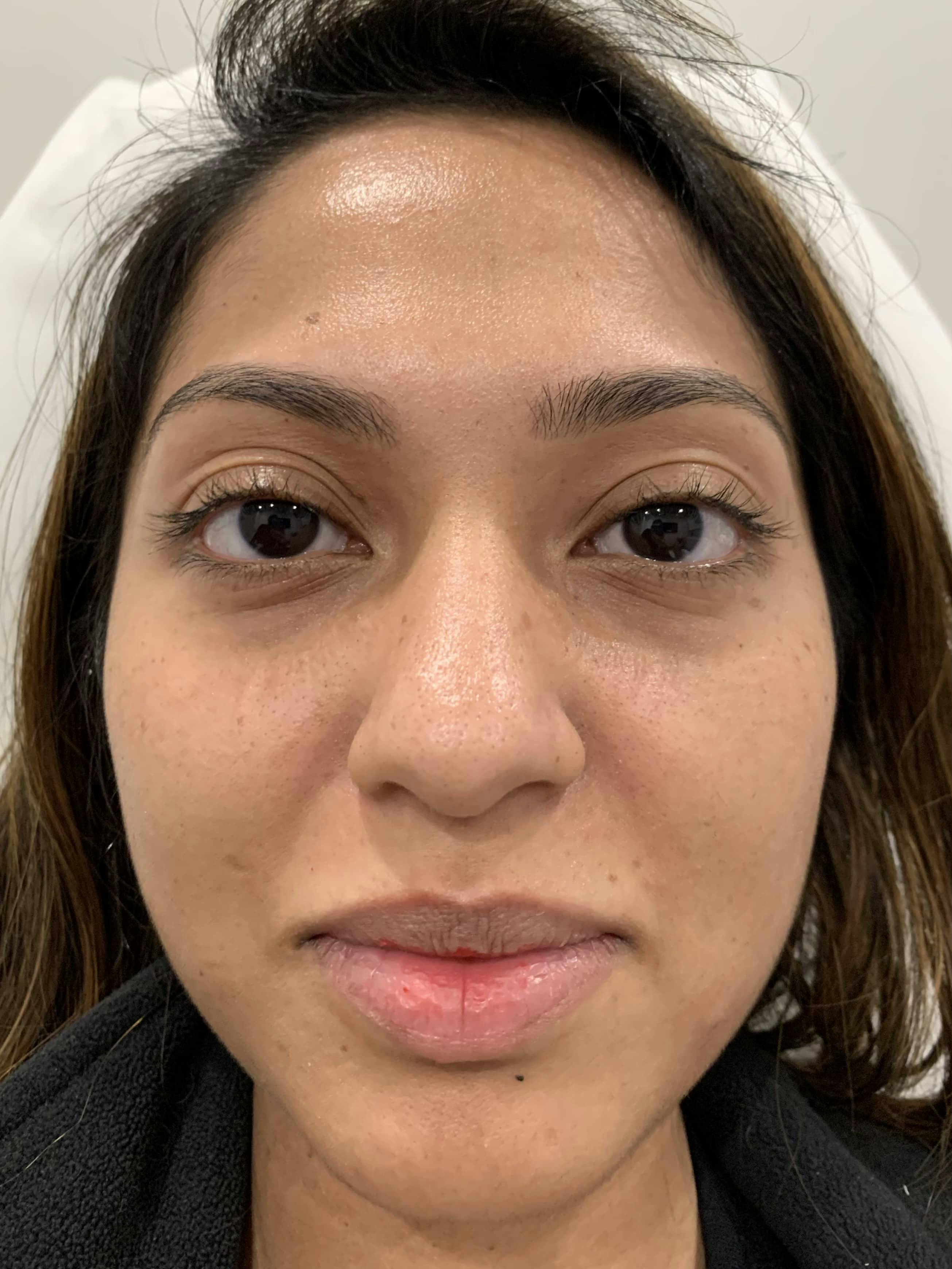 Fillers Before & After Gallery - Patient 393281 - Image 1