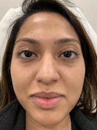 Fillers Before & After Gallery - Patient 393281 - Image 1