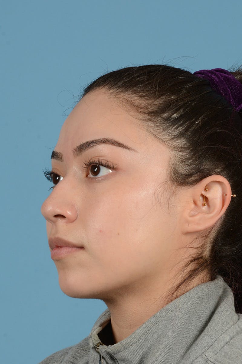 Rhinoplasty Before & After Gallery - Patient 399619 - Image 7