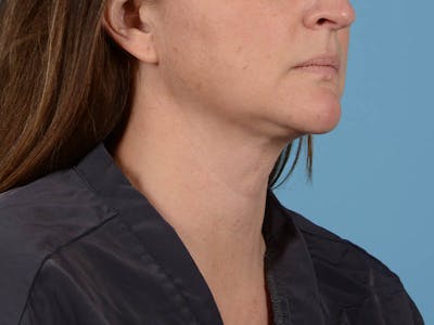 Liposuction Before & After Gallery - Patient 371397 - Image 2