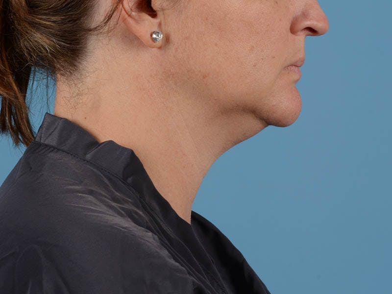 Liposuction Before & After Gallery - Patient 371397 - Image 3