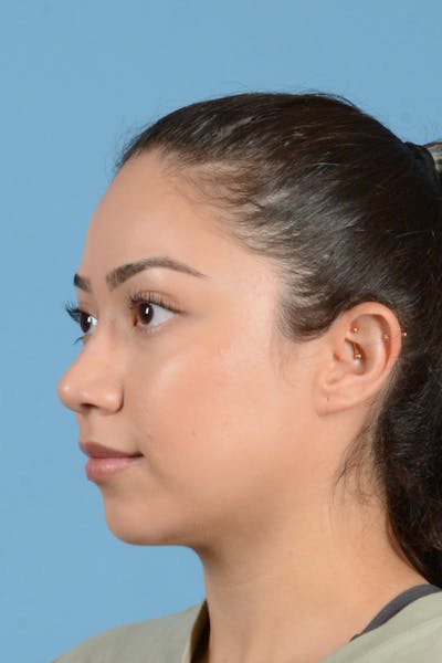 Rhinoplasty Before & After Gallery - Patient 399619 - Image 8
