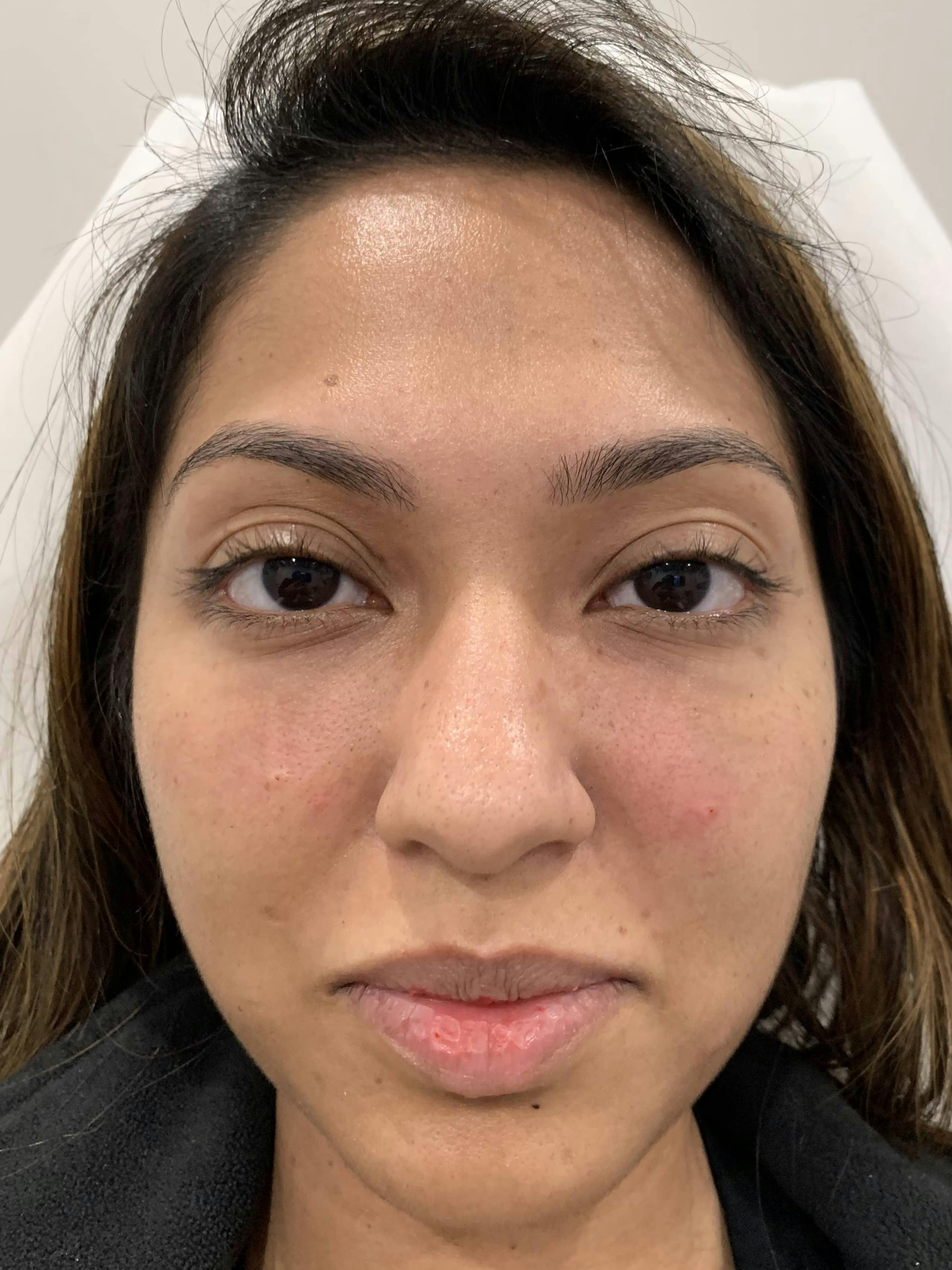 Fillers Before & After Gallery - Patient 393281 - Image 2