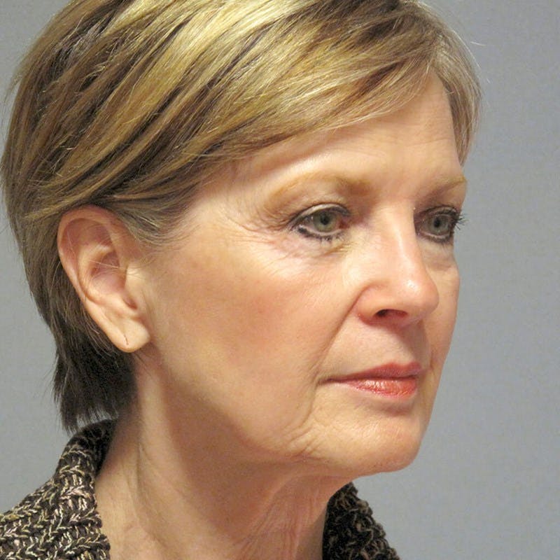 Neck Lift Before & After Gallery - Patient 117700 - Image 3