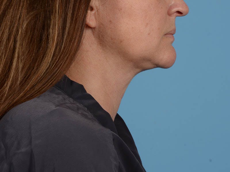 Liposuction Before & After Gallery - Patient 371397 - Image 4