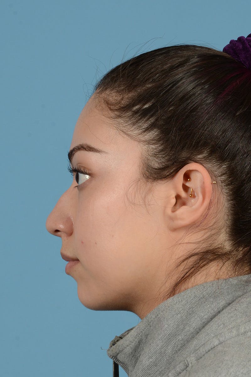 Rhinoplasty Before & After Gallery - Patient 399619 - Image 9