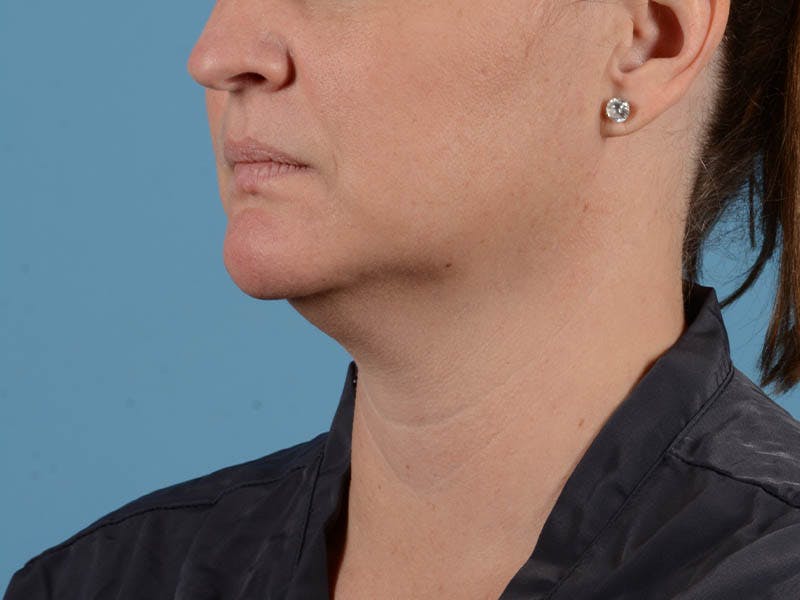 Liposuction Before & After Gallery - Patient 371397 - Image 5