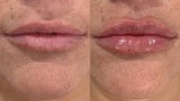 Fillers Before & After Gallery - Patient 129325 - Image 1