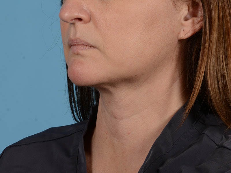Liposuction Before & After Gallery - Patient 371397 - Image 6