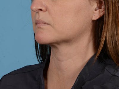 Liposuction Before & After Gallery - Patient 371397 - Image 6