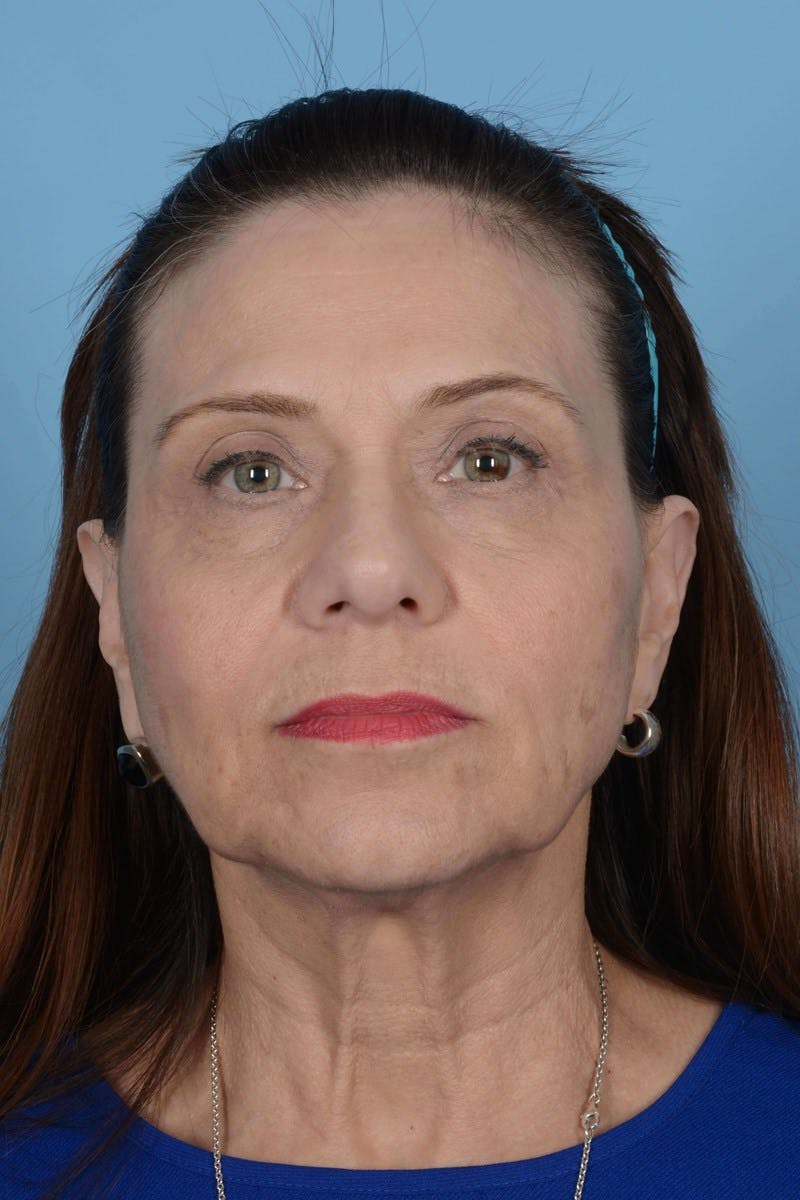 Facelift Before & After Gallery - Patient 356025 - Image 5
