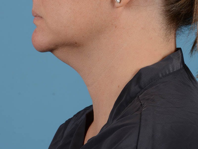 Liposuction Before & After Gallery - Patient 371397 - Image 7