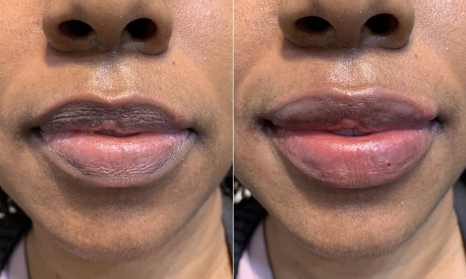 Fillers Before & After Gallery - Patient 130052 - Image 1