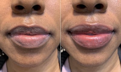 Fillers Before & After Gallery - Patient 130052 - Image 1