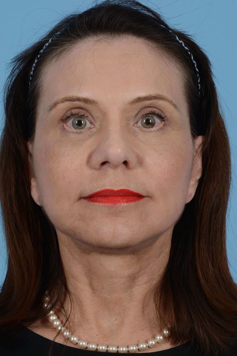 Facelift Before & After Gallery - Patient 356025 - Image 6