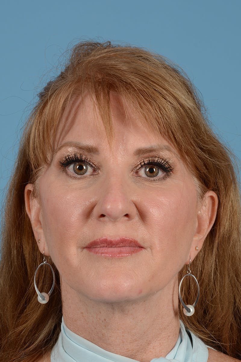 Rhinoplasty Before & After Gallery - Patient 168190 - Image 1