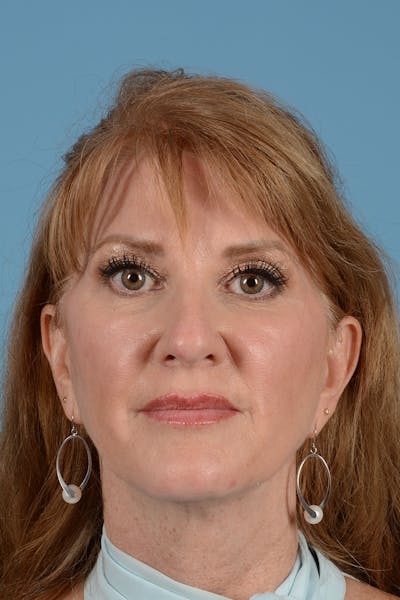 Rhinoplasty Before & After Gallery - Patient 168190 - Image 1