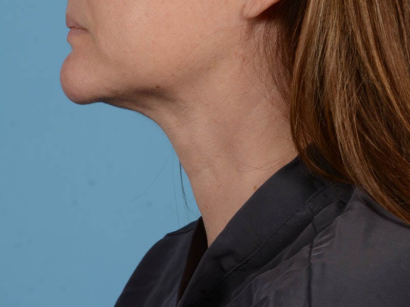 Liposuction Before & After Gallery - Patient 371397 - Image 8