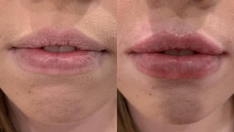 Fillers Before & After Gallery - Patient 405908 - Image 1
